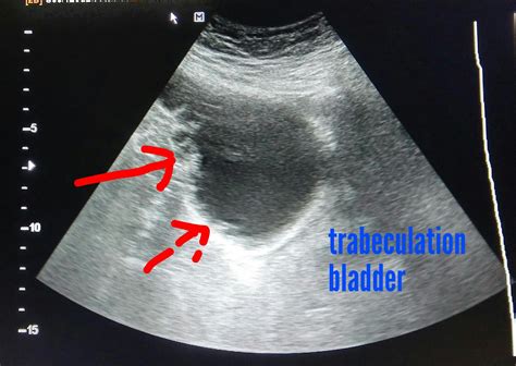 Urinary Bladder