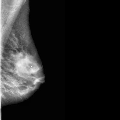 CBIS-DDSM - Dataset Ninja