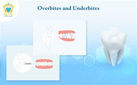Overbite Vs Underbite Dogs at Jack Huffman blog