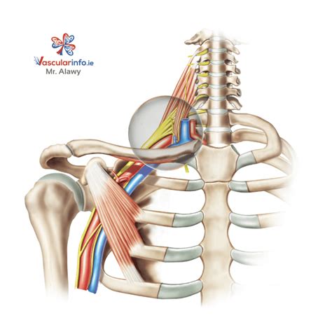 Thoracic Outlet Syndrome - Vascular Info