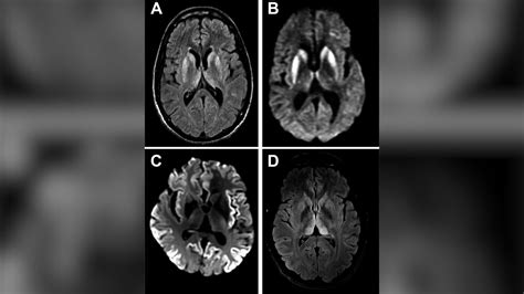 The exceptionally rare disease that causes holes to form in your brain | Live Science