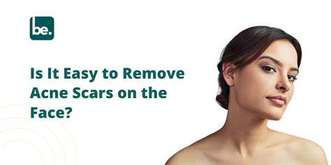 Is It Easy to Remove Acne Scars on the Face? - Belogical Wellness ...
