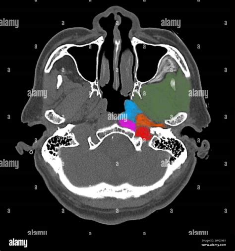 Ct Anatomy Of The Neck