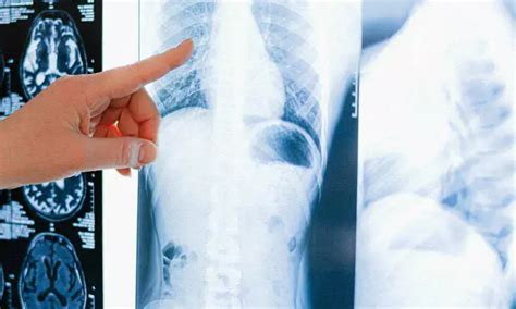 AI detects fatty liver disease with chest X-rays: Study