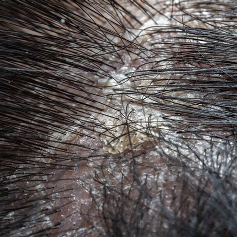 Hongos en el cuero cabelludo: Todo lo que debes saber - Capilica