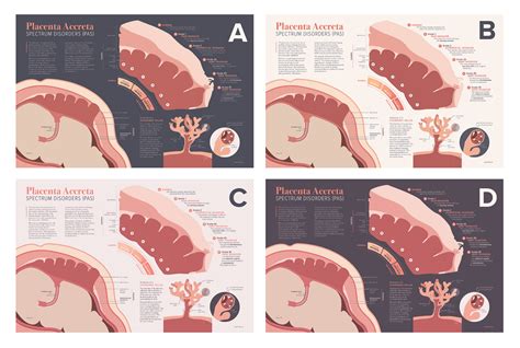 Placenta Accreta Spectrum Disorders on Behance