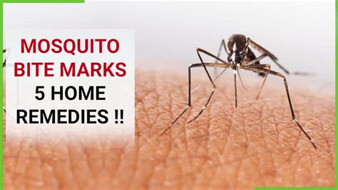 Mosquito Bite Prevention: How To Get Rid Of Red Marks & Itch, Effective ...