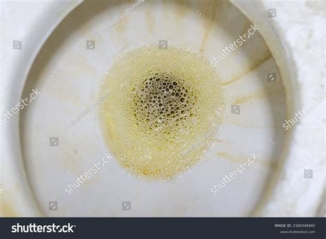 Foamy Urine