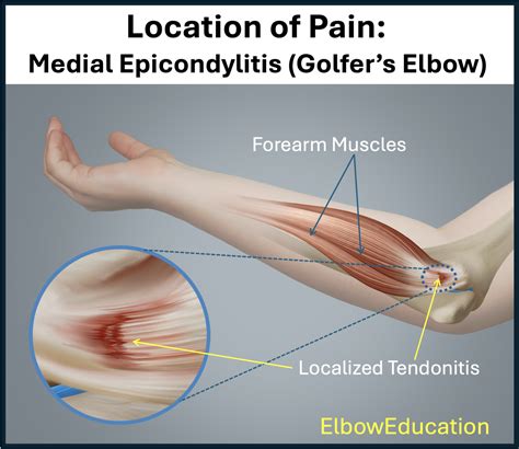 Medial Epicondylitis - Golfer’s Elbow - Elbow Education