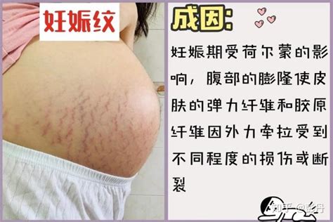 仁和匠心妊娠纹修复霜妊辰纹产后消除紧致肚皮孕妇预防淡化护理-Taobao