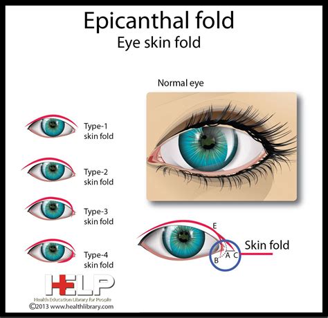 Epicanthal Folds Vs Normal Eye - EMSEKFLOL.COM