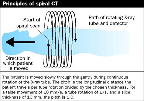 Spiral Ct Vs Multislice Ct at Regina Bruce blog