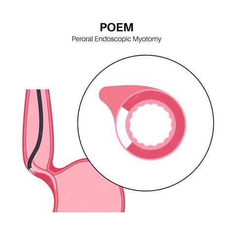 Premium Vector | Peroral endoscopic myotomy poem minimally invasive procedure disorder of the ...
