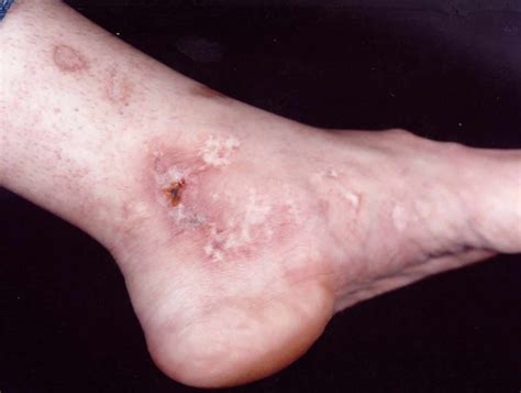 Mottled skin or livedo reticularis causes, diagnosis and treatment