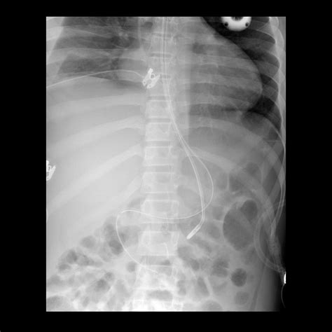 G Tube Placement X Ray at Gayla Wilson blog