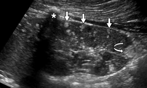 Left Kidney Ultrasound
