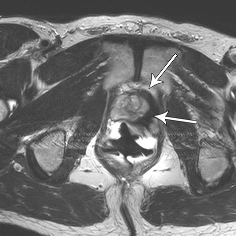 Mri Of Prostate