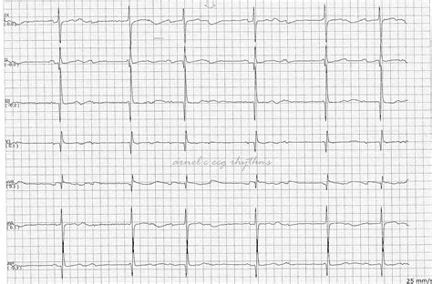 Complete Heart Block Ekg