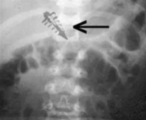 Image result for Alien Implants Just Schrapnel