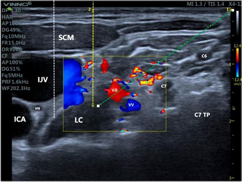 Frontiers | Ultrasound-guided stellate ganglion blockade – patient ...