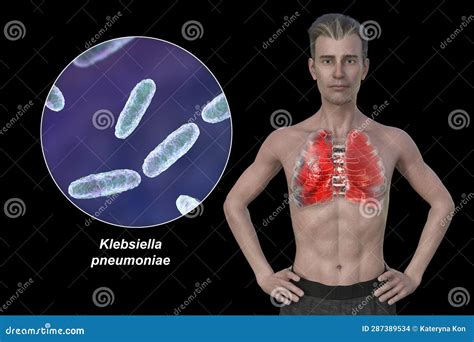 A Man with the Lungs Affected by Pneumonia, and Close-up View of Klebsiella Pneumoniae Bacteria ...