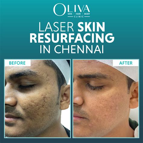 Laser Skin Resurfacing In Chennai: Cost, Results & Procedure