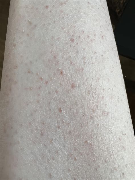How to get rid of a ton of ingrown hairs on my legs? : r/Skincare_Addiction