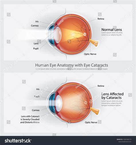 Vision Disorder 的图像结果