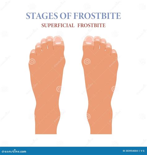 Frozen Toes. Stages of Frostbite of Fingers. Healthcare and Medicine Stock Vector - Illustration ...