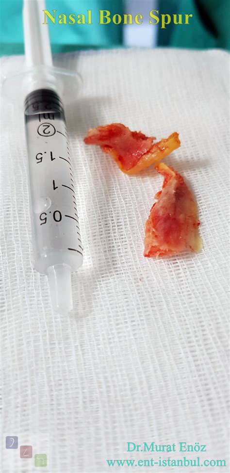 HealthZone Turkey – Medical Articles, Doctor's Guides & Latest Health News: Nasal Bone Spur ...