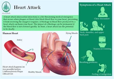 Heart Attack Pain Diagram WebMD Women Have Different Heart Attack
