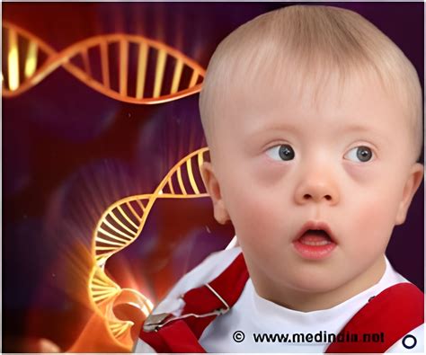 Image result for Intellectual Disability Causes