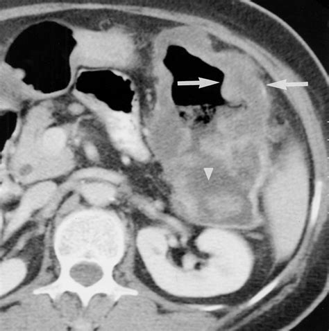 CT of Bowel Wall Thickening Significance and Pitfalls of Interpretation | AJR