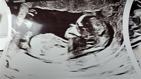 12 weeks 6 days scan. Would love to hear if anyone has any opinions ...
