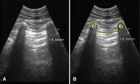 Table 1 from Frequency and number of ultrasound lung rockets (B-lines) using a regionally based ...