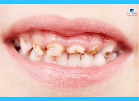 What Happens To Teeth From Sucking Fingers? | Expert's Take