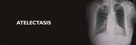 Atelectasis: Causes, Symptoms, Diagnosis & Treatment