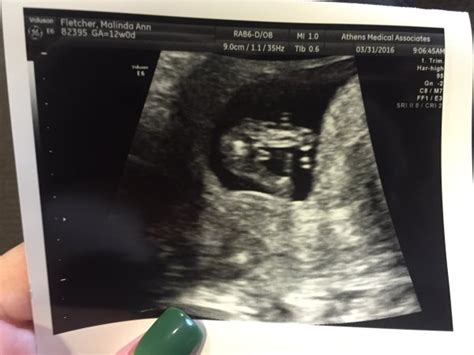 Anyone find out gender at 11-13 week NT scan!?!? | BabyCenter