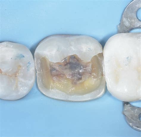 Horizontal Cracks in Teeth — Alleman Center of Biomimetic Dentistry
