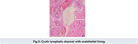 Intra Scrotal Lymphangioma Presenting as Hydrocele