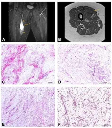 The Role of Methylation Analysis in Distinguishing Cellular Myxoma from ...