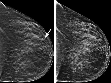 Normal Mammogram Results