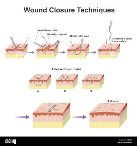 wound closure techniques Stock Photo - Alamy