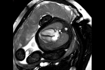 Fetal Cardiac with smart-sync | Philips MR Body Map