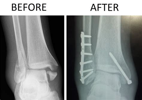 BIMALLEOLAR AND TRIMALLEOLAR FRACTURES - ACE Physical Therapy and ...