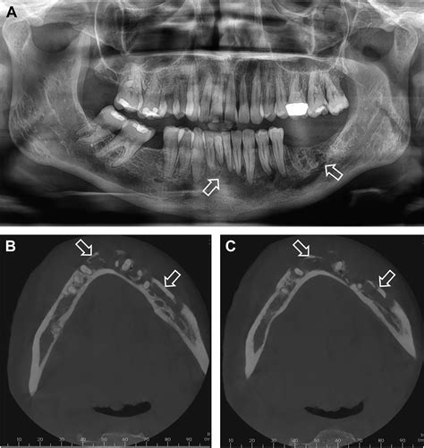 Inflammatory Lesions of the Jaws - Dental Clinics