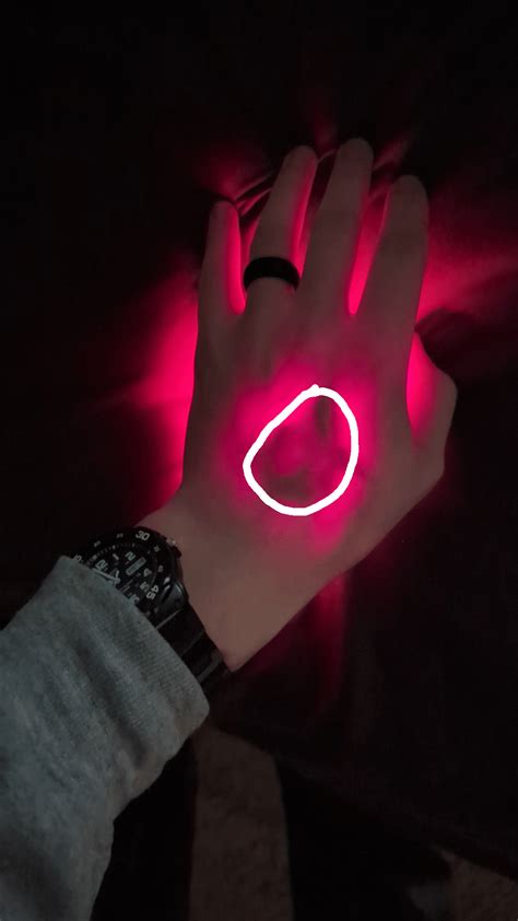 Blown Vein From Attempted IV Placement Yesterday. Shown via My Triple ...