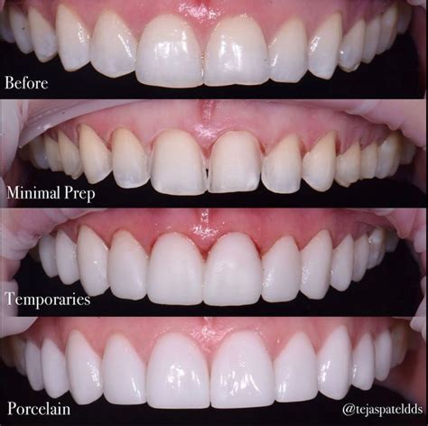 What are dental veneers? | Cosmetic teeth, Dental veneers, Perfect teeth
