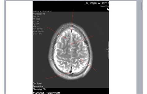 Brain CT Scan 的图像结果