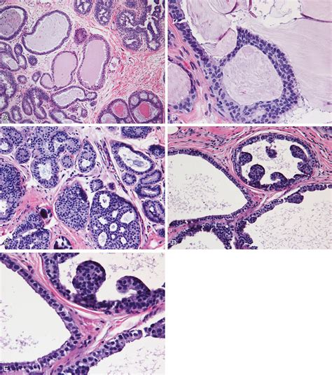 What Is Focal Columnar Cell Change at Carmen Gaines blog